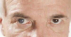 A person with cataracts looking straight at you